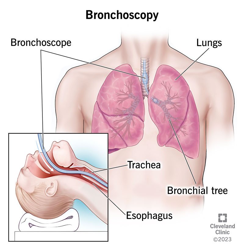 Bronchoscopy